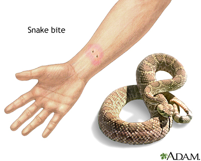 a snake bite